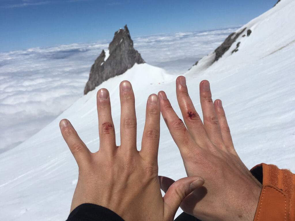 Andy and my knuckles cut up by ice